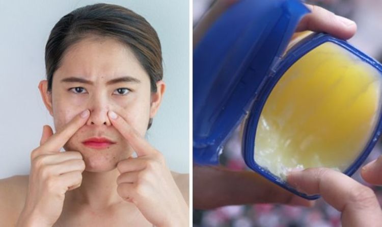 Blackhead removal hack: Why you should NEVER use Vaseline to get rid of blackheads