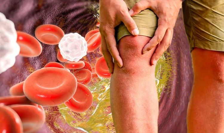 High cholesterol symptoms: The sensation in your legs that signals high cholesterol levels