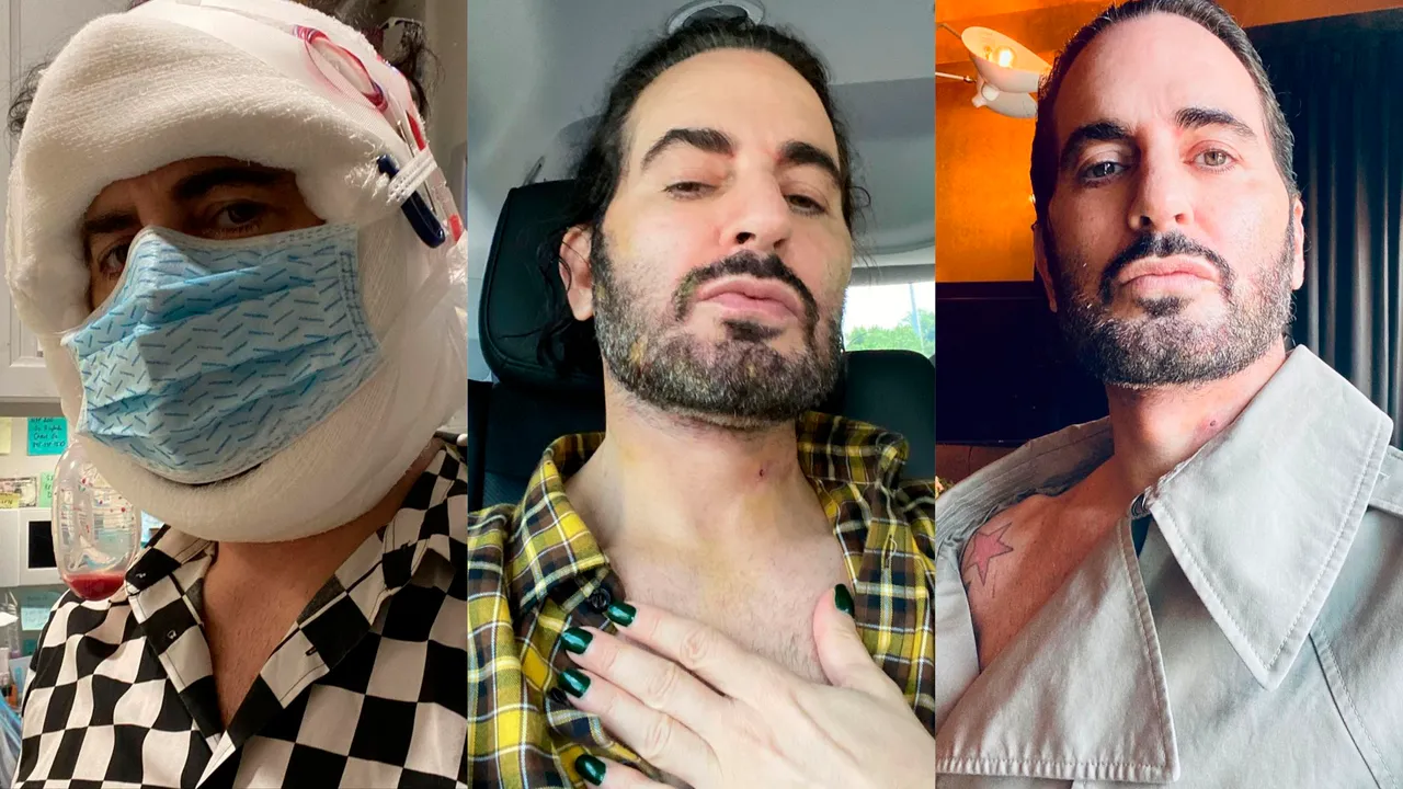 Marc Jacobs Opens Up About His Facelift, and Encouraging a New Era of Transparency Around Plastic Surgery