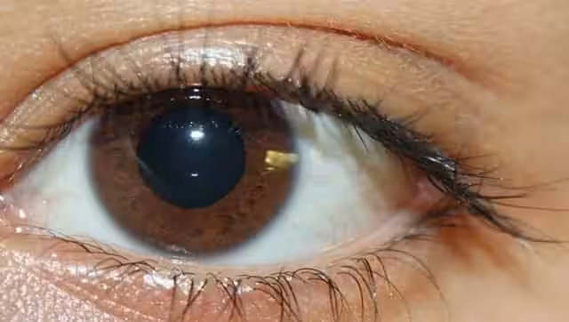 International Nystagmus Day 2021: Significance of day that raises awareness about severe vision problem-Health