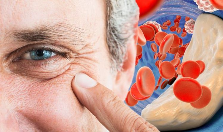 High cholesterol symptoms: The major warning sign ‘around your eyes’ - doctor's advice