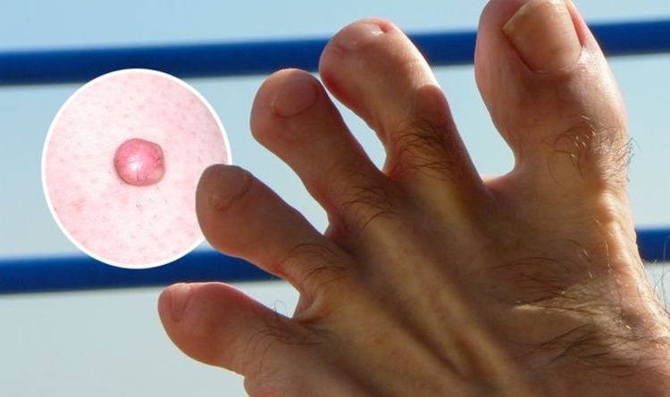 High cholesterol symptoms: The warning sign of high cholesterol levels on your toes