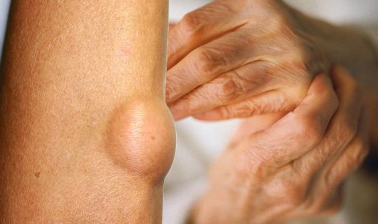 Rheumatoid arthritis symptoms: Lumps under skin of bony areas is a warning sign