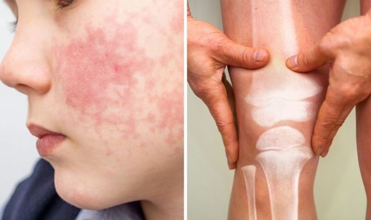 Lupus symptoms: What is lupus, what are the signs?