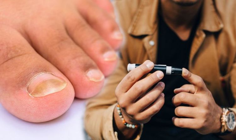 Type 2 diabetes: Are your nails yellow? Unusual signs of diabetes on your hands and feet