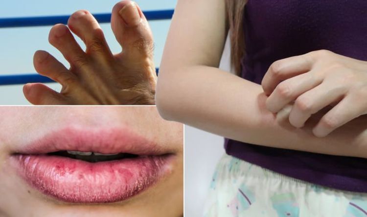 Covid rash warning - the three symptoms of coronavirus on your skin