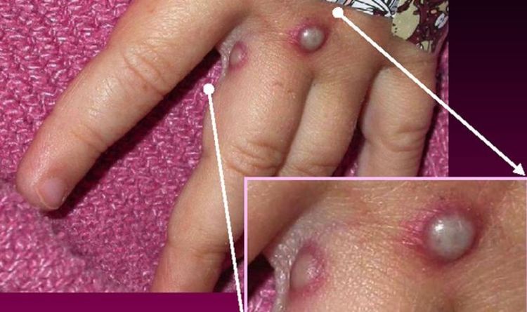 Monkeypox UK: Where has monkeypox been found in UK? Is it dangerous?