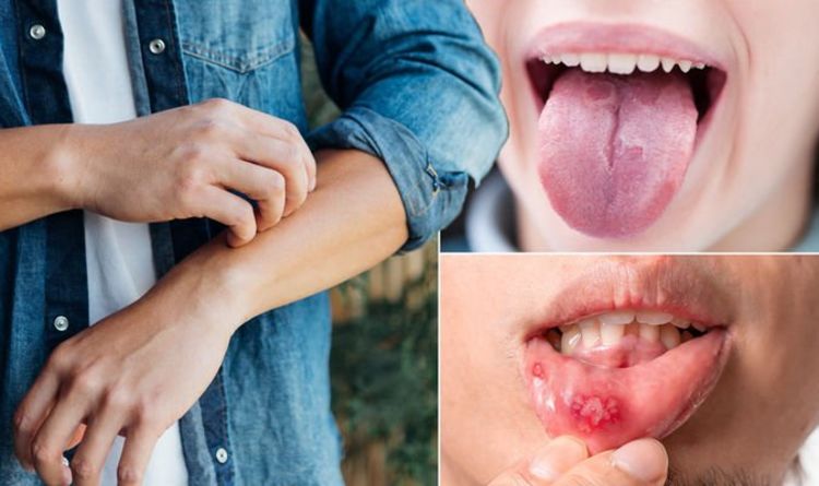 Covid warning: What are the 'uncommon' symptoms of coronavirus? Expert explains full list