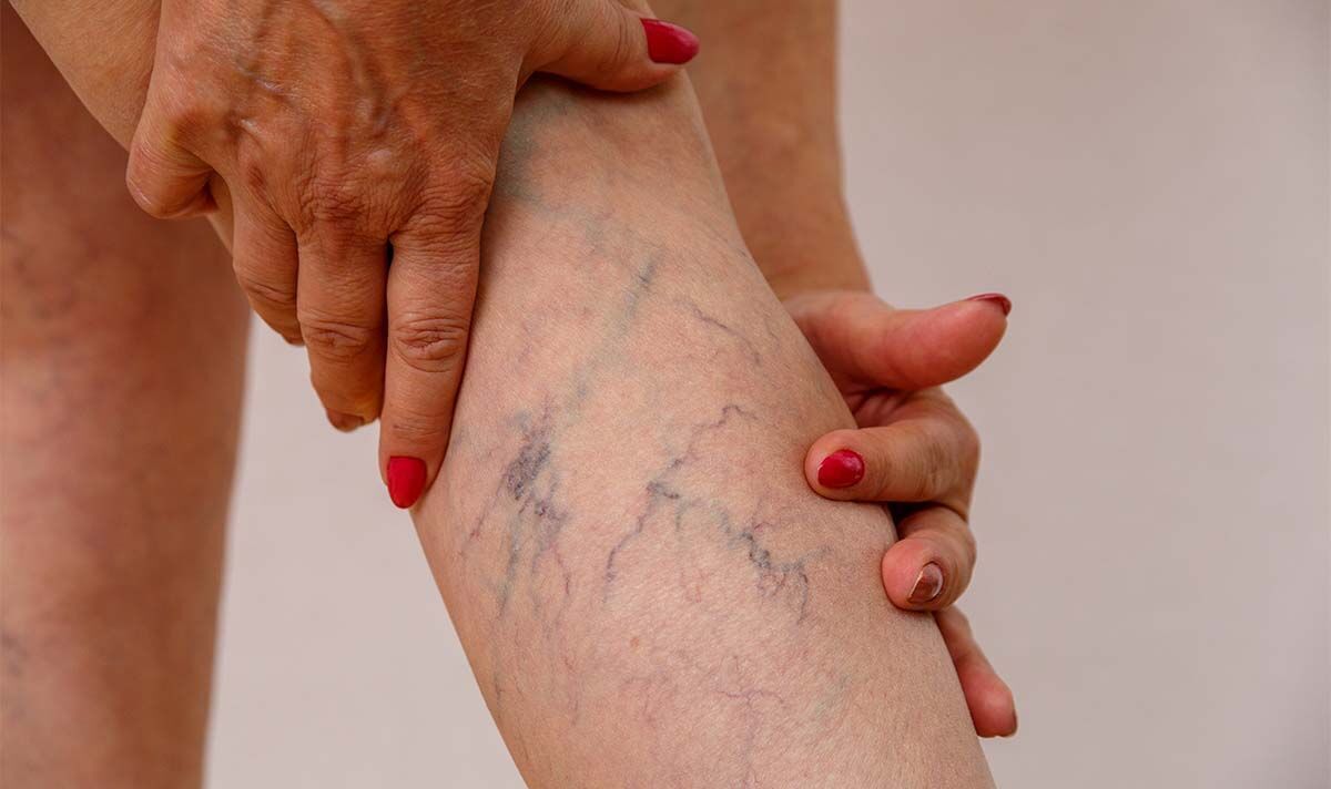 Three 'sudden' signs of a blood clot in the legs