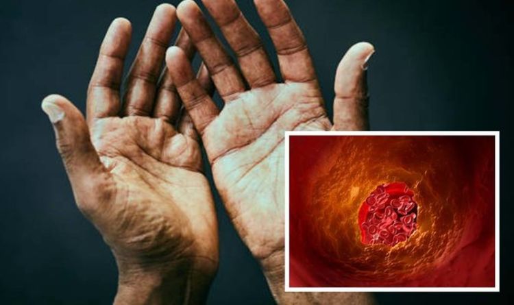 High cholesterol: The sign on your eyes, palms, or lower legs 'you have unhealthy levels'