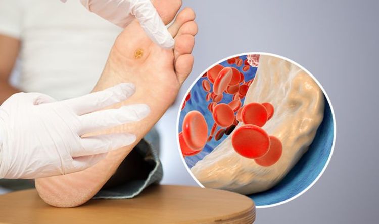 High cholesterol: Three signs on your foot that 'require immediate medical attention'