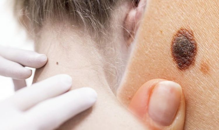 Skin cancer: Eight major signs warning your blemish or mole may be cancerous
