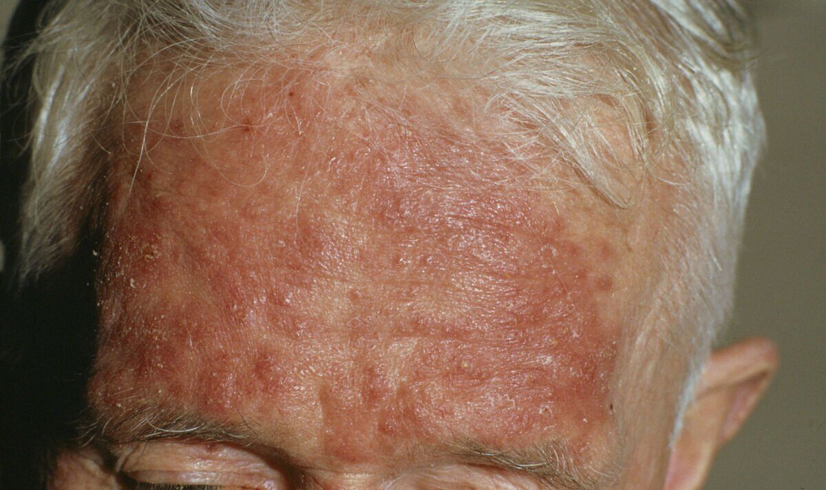 'Visible’ sign of fatty liver disease that can appear on the face