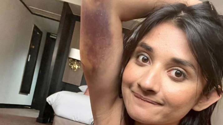 Khatron Ke Khiladi 12: 'Guddan' actress Kanika Mann badly bruised during shoot but smiles like a warrior