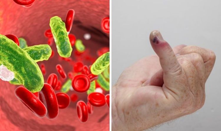 Sepsis symptoms: What causes sepsis? How to prevent the deadly condition