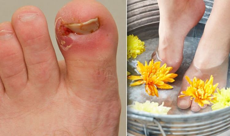 How to get rid of an ingrown toenail