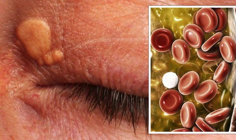 High cholesterol symptoms: The ‘minor growths’ on your face that indicate high levels