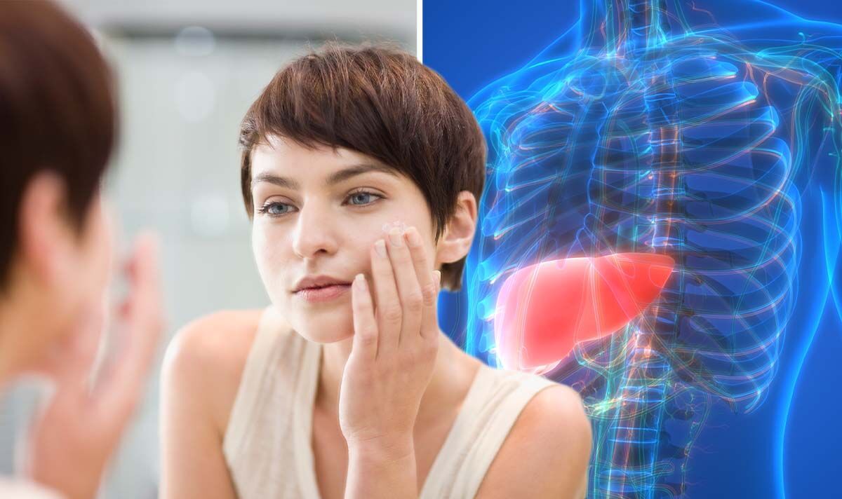 Fatty liver disease: The spider-like sign on your face, neck and arms - how to spot it