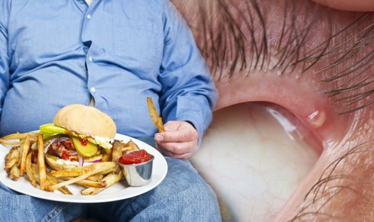 High cholesterol: Xanthelasma relates to yellow patches around the eyes and is a warning s