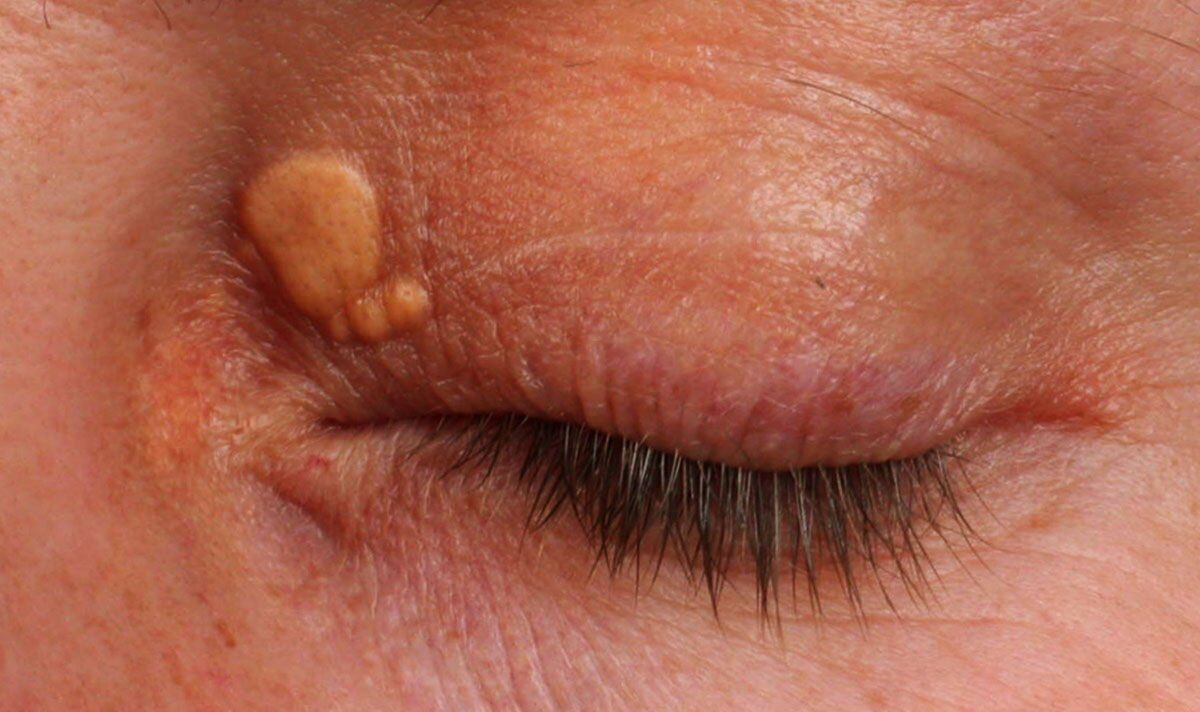 Fatty liver sign on eyelids could signal the condition is worsening