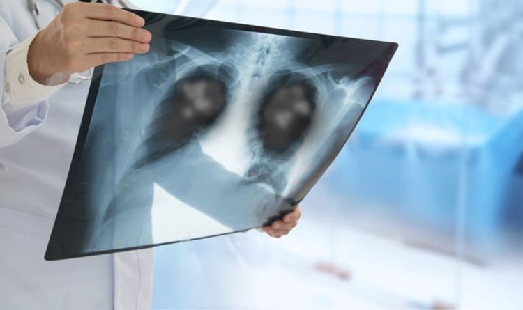 Lung cancer cases missed as symptoms mistaken for Covid - thousands more died