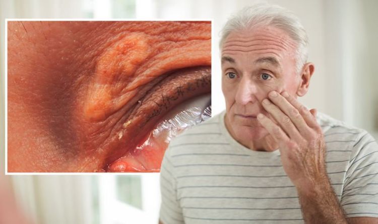 High cholesterol: The sign on your face that can be 'itchy or tender to touch' - doctor