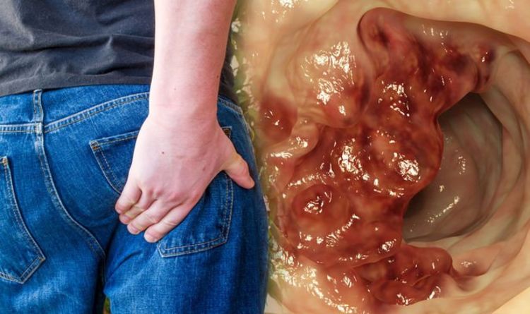 Colon cancer: Pain in the rectum with a feeling of needing to dispel your stools is a sign