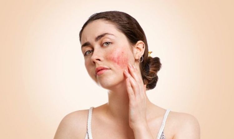 Acne Rosacea: What's the difference between Acne and Acne Rosacea?