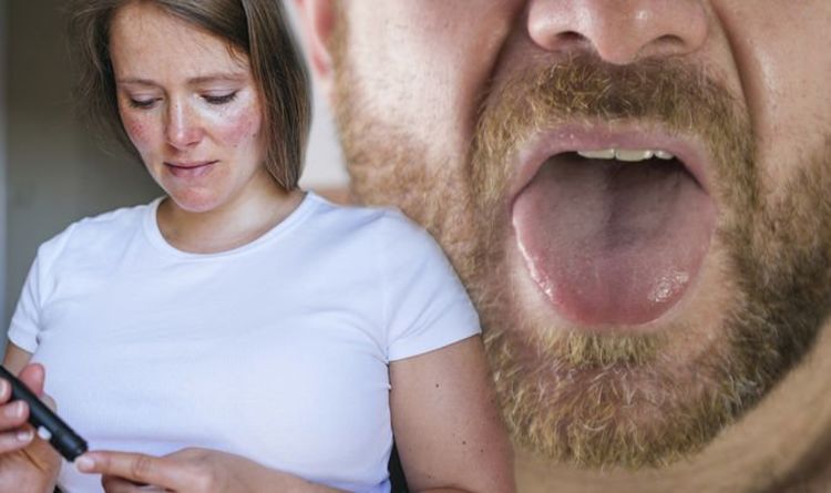 Diabetes type 2: The three main indicators of high blood sugars found in your mouth