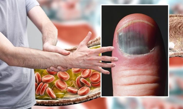 High cholesterol symptoms: Thin dark lines under your nails could be a sign