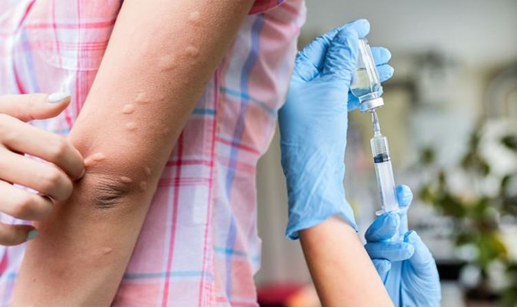 Pfizer vaccine side effects: Four unsettling skin reactions linked to coronavirus vaccine